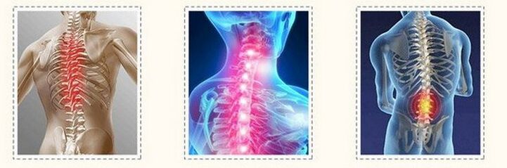 Osteochondrosis of different spine