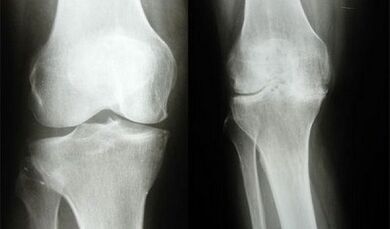Methods of diagnosis of knee