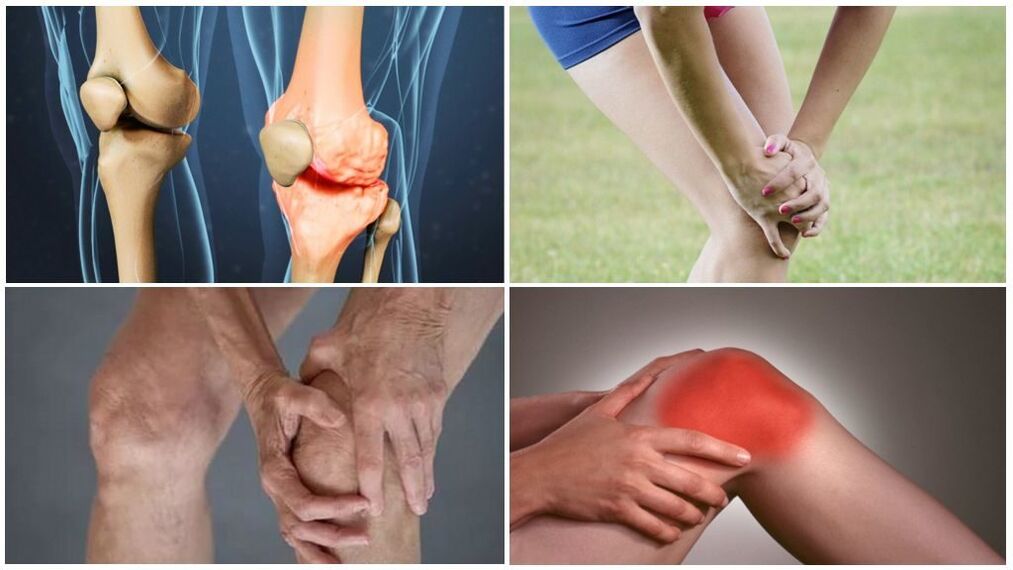 The stages of arthrosis
