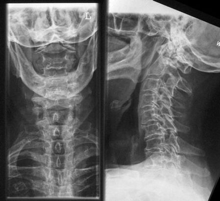 Method of diagnosis of cervical x -ray - osteochondrosis