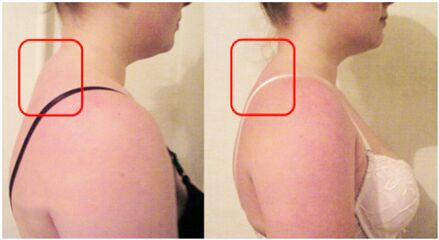 The formation of muscle attraction with cervical osteochondrosis