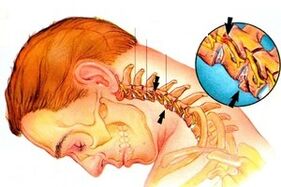 Nerve pinching in the spine with cervical osteochondrosis
