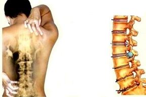 Spinal pain at various stages of development of cervical osteochondrosis