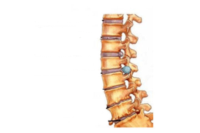 Spine damage with cervical osteochondrosis