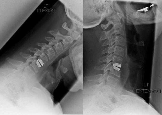 A picture of the spine after surgery