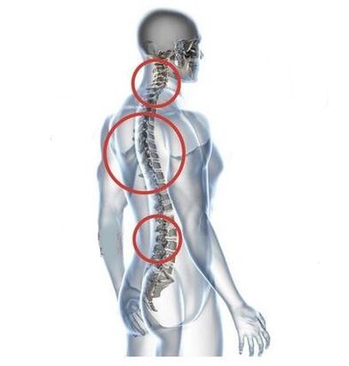 Areas of spinal osteochondrosis