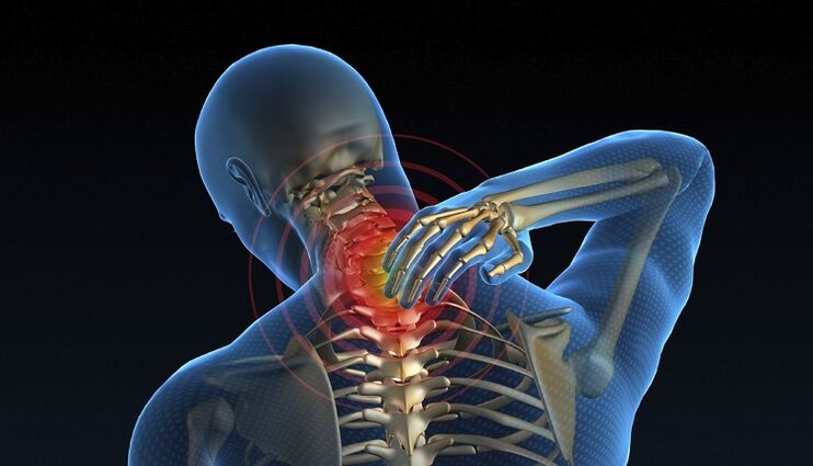 A pinched nerve in the spine as a cause of low back pain