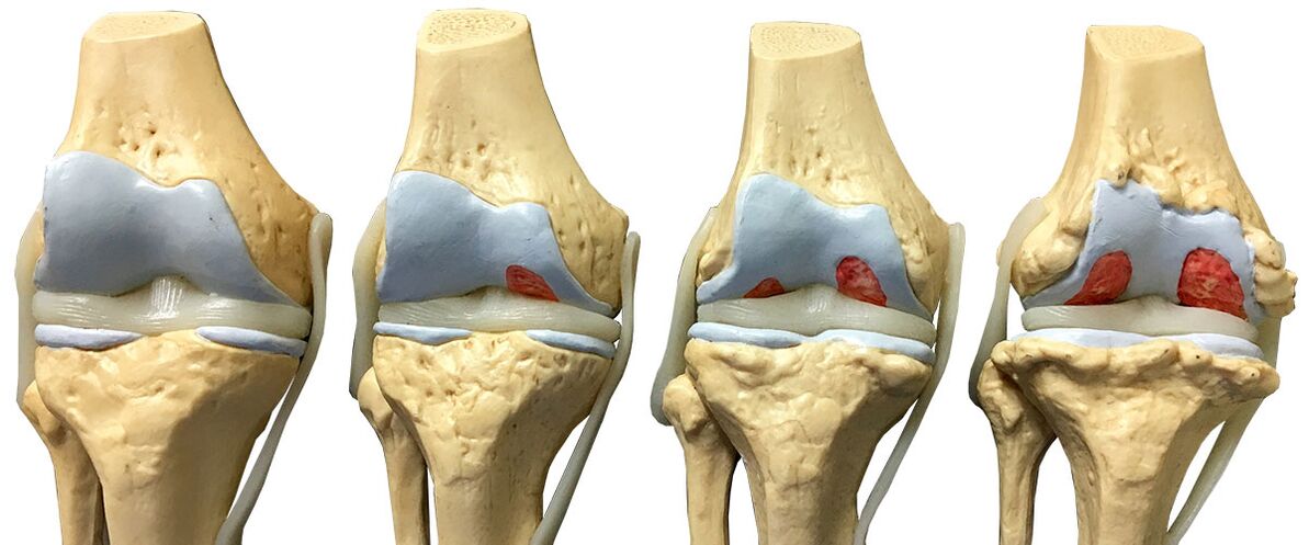Stages of arthrosis