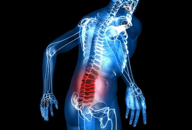 What is lumbar osteochondrosis
