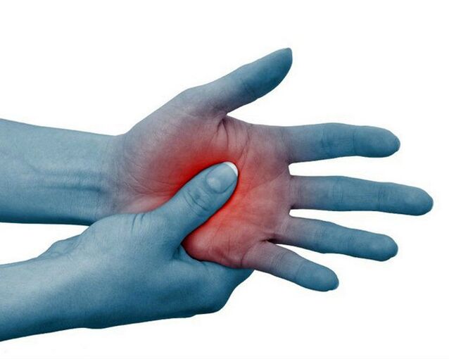Severe pain in the joints of the fingers, which decreases with exercise, is a typical sign of rheumatoid arthritis.